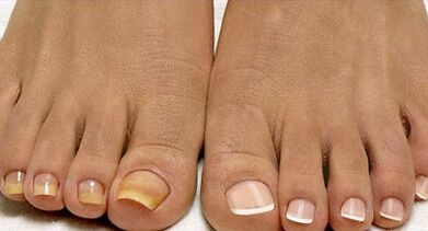 Filo mantar tedavi yöntemleri