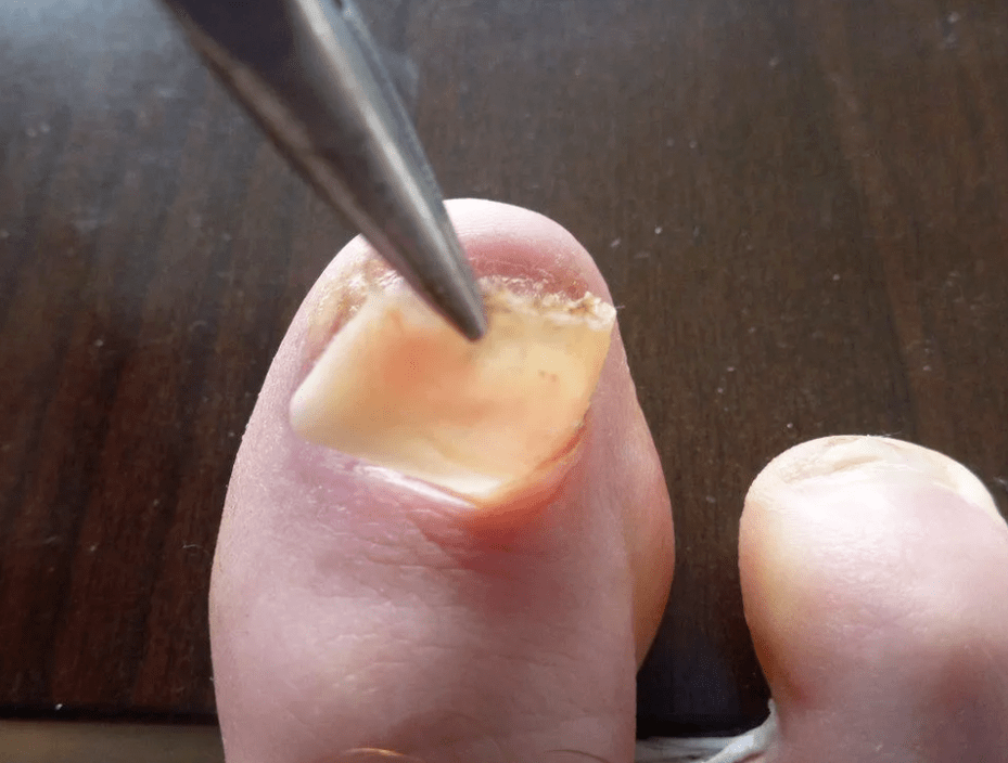 Plakanın çıkarılması