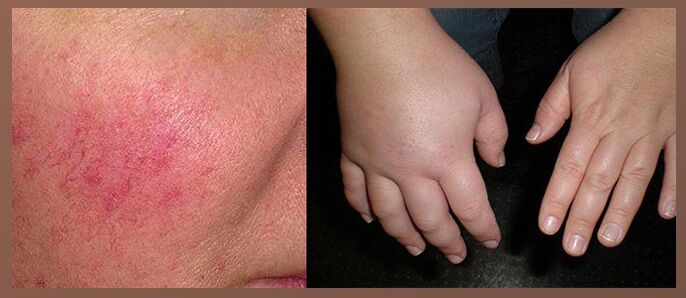 Damlaların yan etkileri